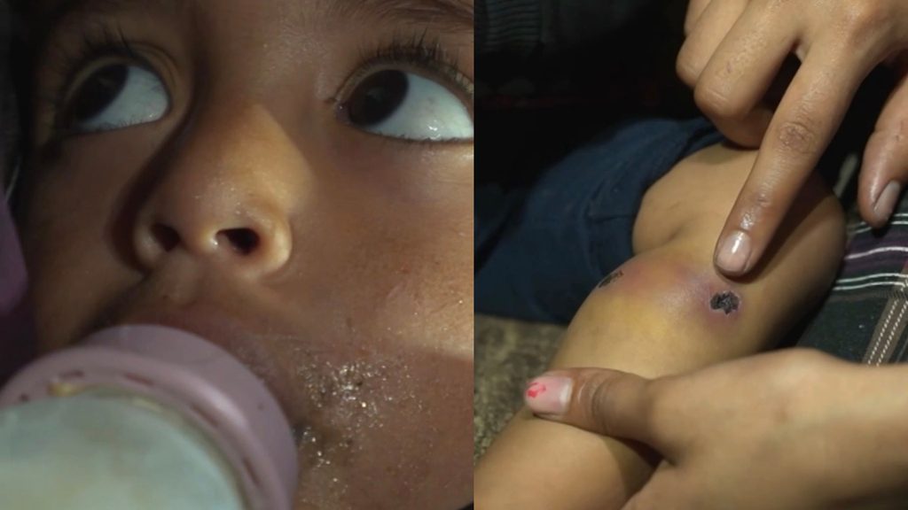 A Palestinian toddler was tortured by Israeli forces with medical reports showing cigarette burns on his thigh